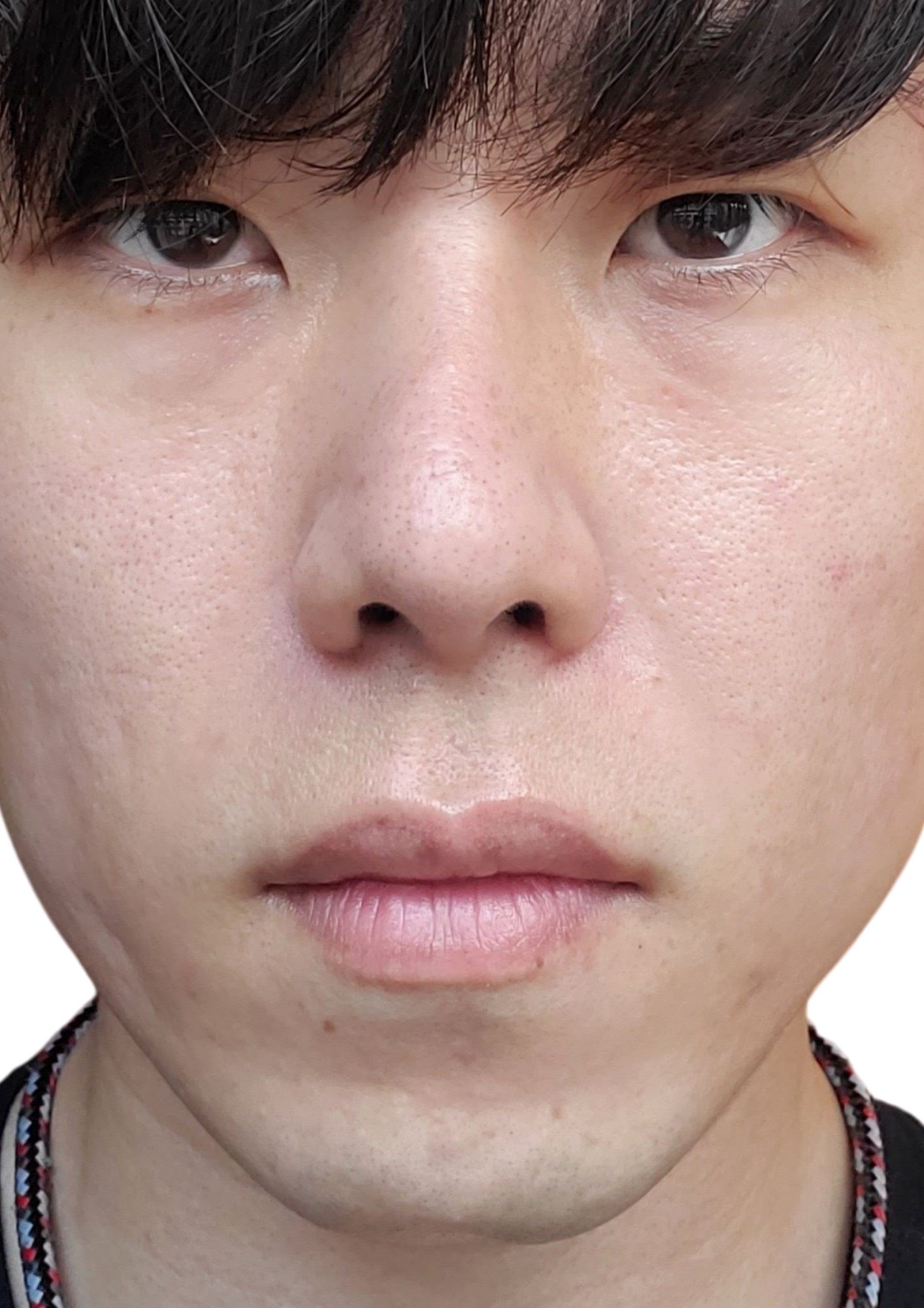 鼻整形アフター 鼻整形アフター